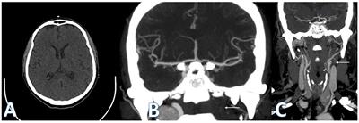 Case report: Flow changes in routes of collateral circulation in patients with LVO and low NIHSS: a point favor to treat